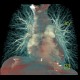 Chronic lung embolism, VRT: CT - Computed tomography